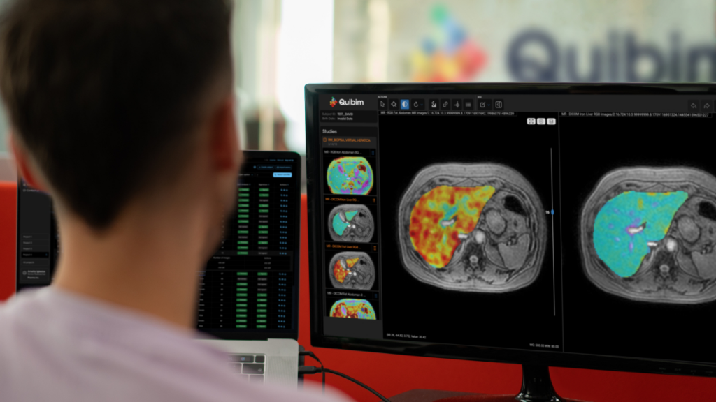 Quibim QP-Insights platform showing AI-powered brain imaging analysis for precision medicine