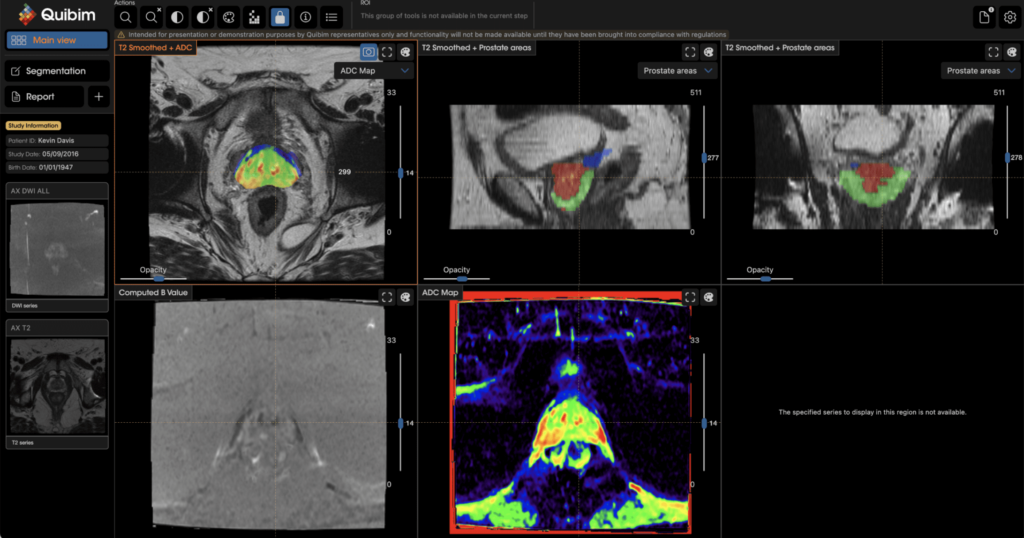 Quibim QP-Prostate