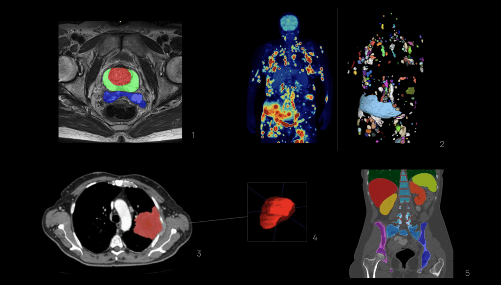 Quibim AI platform analyzing MRI, CT, and PET scans for early disease detection